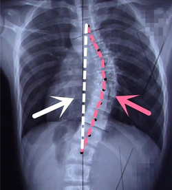 脊柱側(cè)彎后身高會(huì)變短嗎？