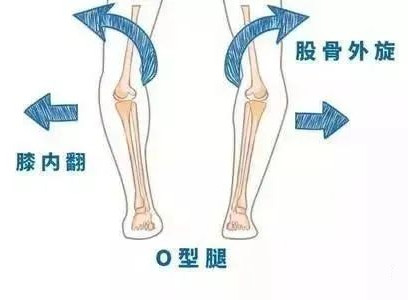 孩子“O”型腿怎么辦？