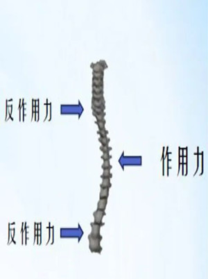 什么是脊柱側(cè)彎矯形器？