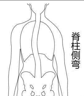 脊柱側(cè)彎康復(fù)訓(xùn)練主要從四個方面入手！