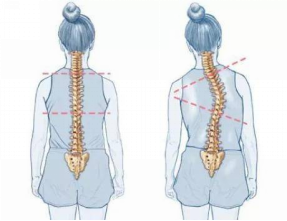 怕耽誤學(xué)習(xí)，脊柱側(cè)彎就不治療了嗎？