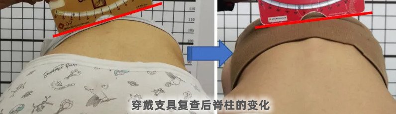 脊柱側(cè)彎支具穿戴3個(gè)月要及時(shí)復(fù)查