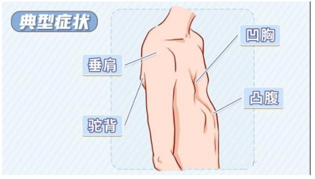 漏斗胸怎么矯正？