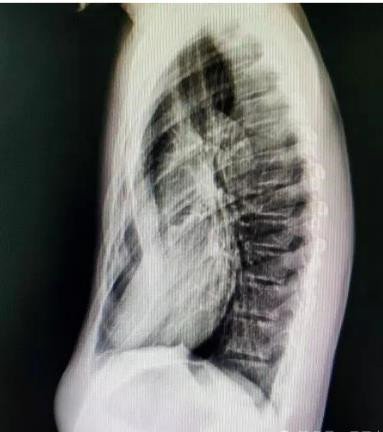 漏斗胸怎么矯正？