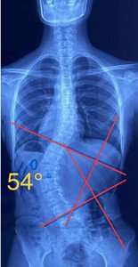 睡姿對脊柱側(cè)彎患者的影響