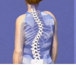 成人脊柱側(cè)彎怎么辦？